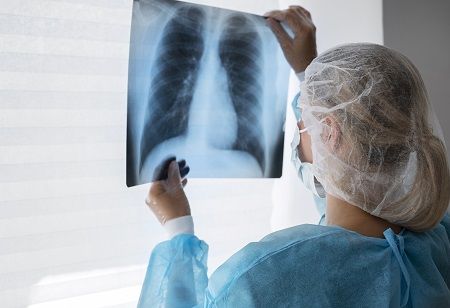 Google Integrates Machine Learning Algorithms for Lung Cancer Screening